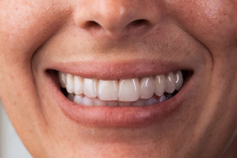 Sonrisa con alineador KeepFlex
